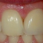 Tooth Replacement After