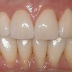 Upper Arch Rehab After