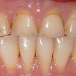 Upper Arch Rehab Before