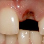 Tooth Replacement Before